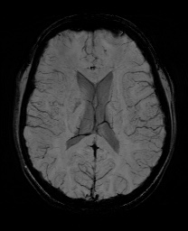 Cerebral cavernous venous malformation (Radiopaedia 70008-80021 Axial SWI 40).jpg