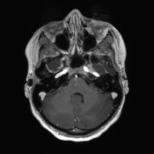 File:Cerebral cavernous venous malformation (Radiopaedia 70008-80021 Axial T1 C+ 15).jpg