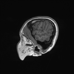 File:Cerebral cavernous venous malformation (Radiopaedia 70008-80021 Sagittal T1 68).jpg