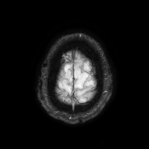 Cerebral cavernous venous malformation (Zabramski type II) (Radiopaedia 85511-101198 Axial SWI 107).jpg