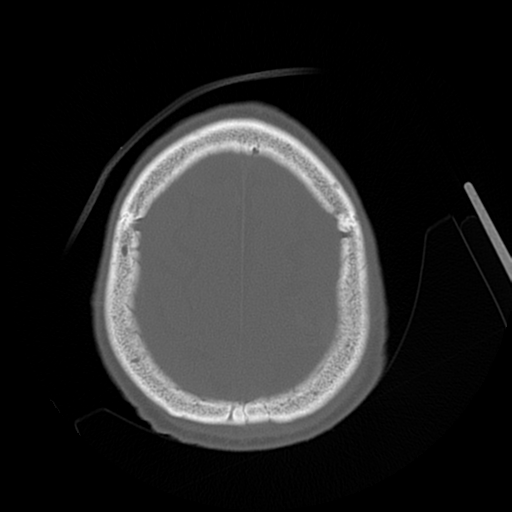 Cerebral contusions, subarachnoid hemorrhage and subdural hygromas (Radiopaedia 55399-61827 Axial bone window 44).png