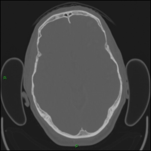 Cerebral contusions (Radiopaedia 33868-35039 Axial bone window 85).jpg