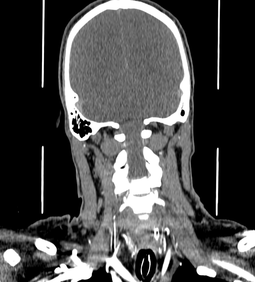 Cerebral edema in an overdose patient (Radiopaedia 72005-82539 B 118).jpg