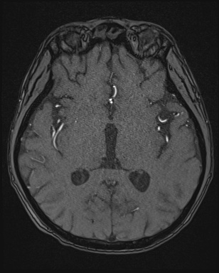 Cerebral embolic infarcts (embolic shower) (Radiopaedia 72391-82921 Axial MRA 90).jpg