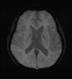 Cerebral embolic infarcts (embolic shower) (Radiopaedia 72391-82921 Axial SWI 40).jpg