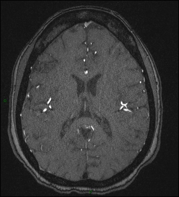 Cerebral fat embolism (Radiopaedia 35022-36525 Axial TOF 124).jpg