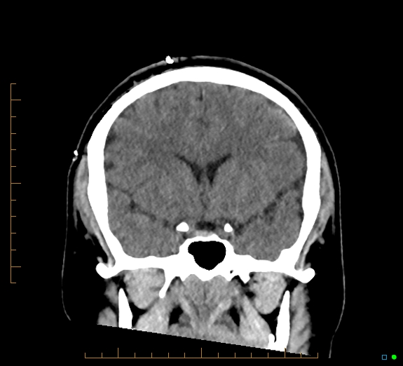 Cerebral fat embolism (Radiopaedia 85521-101224 Coronal non-contrast 26).jpg
