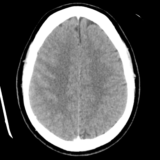 Cerebral hemorrhage secondary to arteriovenous malformation (Radiopaedia 33497-34561 B 39).png