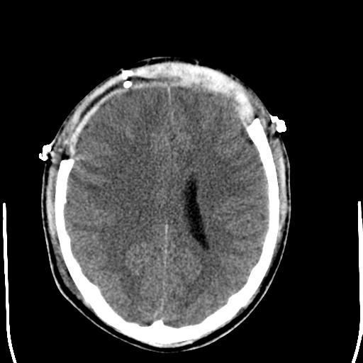 File:Cerebral hemorrhagic contusions- temporal evolution (Radiopaedia 40224-42755 AXIAL THICK 20).png