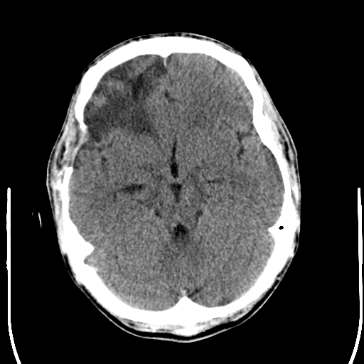 File:Cerebral hemorrhagic contusions- temporal evolution (Radiopaedia 40224-42756 Axial non-contrast 9).png