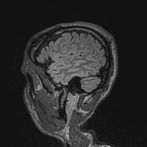 File:Cerebral hemorrhagic contusions- temporal evolution (Radiopaedia 40224-42757 Sagittal T1 15).png