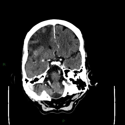 Cerebral metastases - breast primary (Radiopaedia 77653-89857 Axial C+ delayed 36).jpg