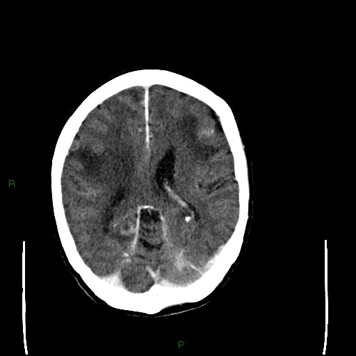 Cerebral metastases - breast primary (Radiopaedia 77653-89857 Axial C+ delayed 70).jpg