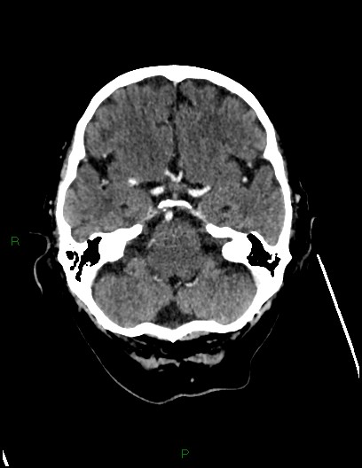 Cerebral metastases - ependymal and parenchymal (Radiopaedia 79877-93131 Axial C+ delayed 21).jpg