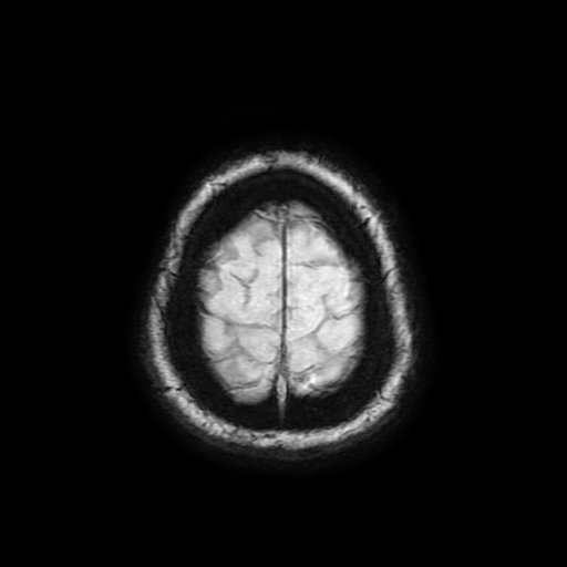 Cerebral metastases - melanoma (Radiopaedia 80972-94522 Axial SWI 91).jpg