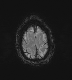 Cerebral metastasis - melanoma (Radiopaedia 54718-60954 Axial SWI 52).png