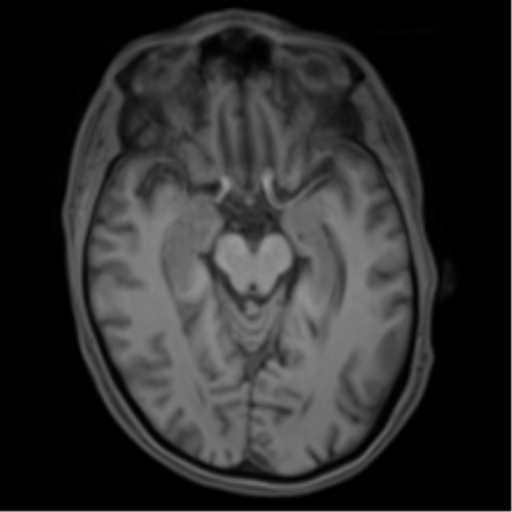 Cerebral metastasis - melanoma (Radiopaedia 54718-60954 Axial T1 22).png