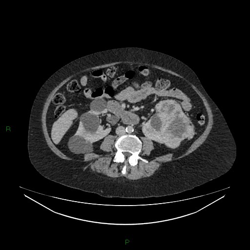 File:Cerebral metastasis from renal cell carcinoma (Radiopaedia 82306-96378 A 97).jpg