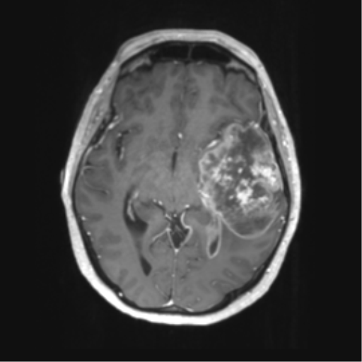 Cerebral metastasis mimicking glioblastoma (Radiopaedia 69155-78937 Axial T1 C+ 28).png
