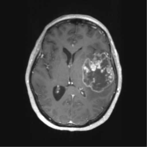Cerebral metastasis mimicking glioblastoma (Radiopaedia 69155-78937 Axial T1 C+ 34).png