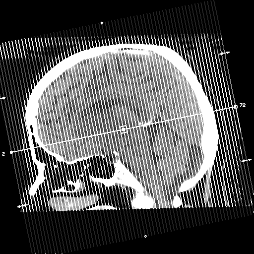 Cerebral metastasis to basal ganglia (Radiopaedia 81568-95412 Coronal non-contrast 1).png
