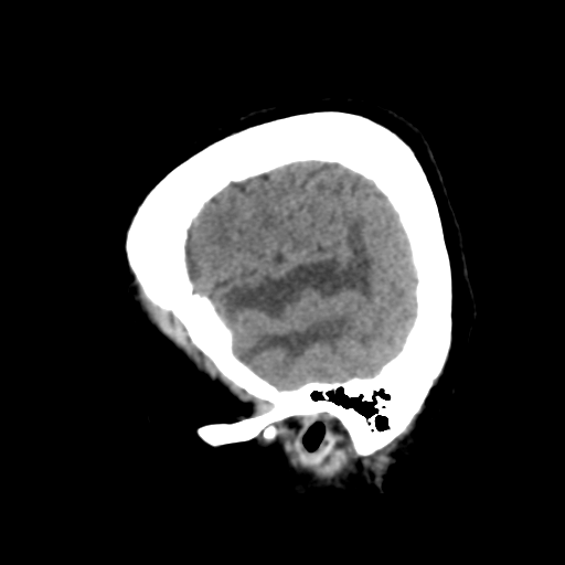 Cerebral metastasis to basal ganglia (Radiopaedia 81568-95412 E 12).png