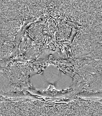 Cerebral metastasis to basal ganglia (Radiopaedia 81568-95413 Axial SWI phase 7).png