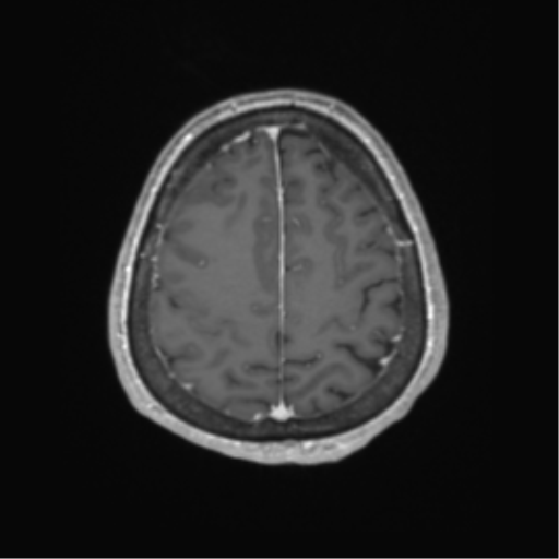 Cerebral metastasis to basal ganglia (Radiopaedia 81568-95413 Axial T1 C+ 60).png