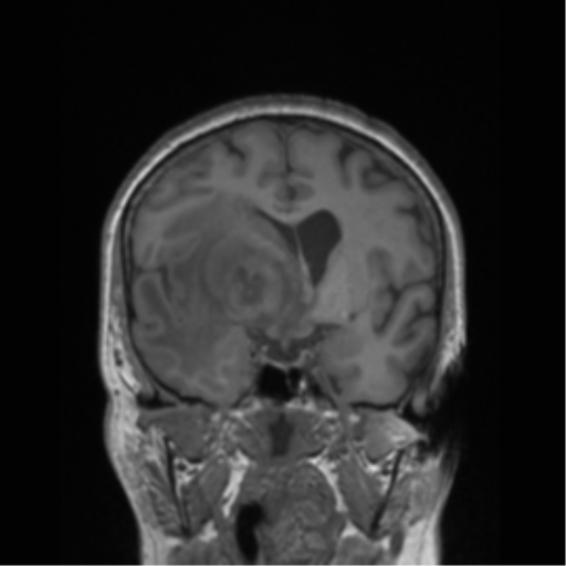 Cerebral metastasis to basal ganglia (Radiopaedia 81568-95413 Coronal T1 33).png