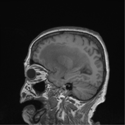Cerebral metastasis to basal ganglia (Radiopaedia 81568-95413 Sagittal T1 54).png