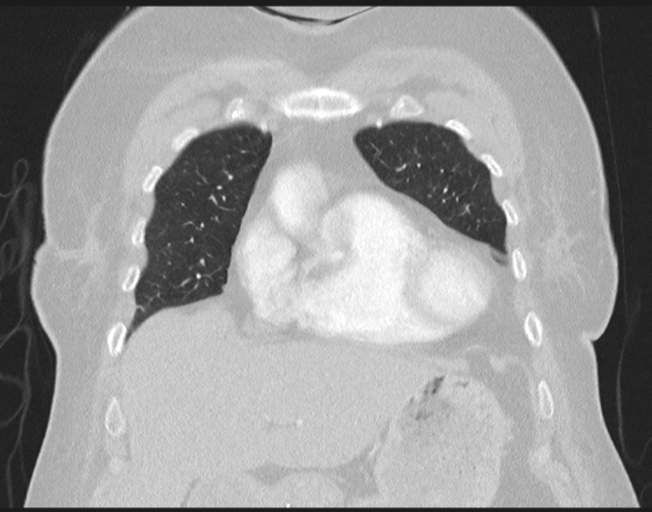 File:Cerebral metastasis to basal ganglia (Radiopaedia 81568-95414 Coronal lung window 25).png