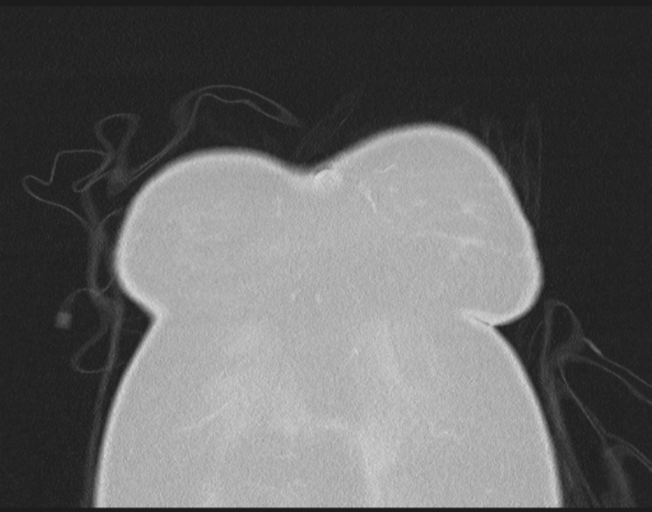 File:Cerebral metastasis to basal ganglia (Radiopaedia 81568-95414 Coronal lung window 8).png