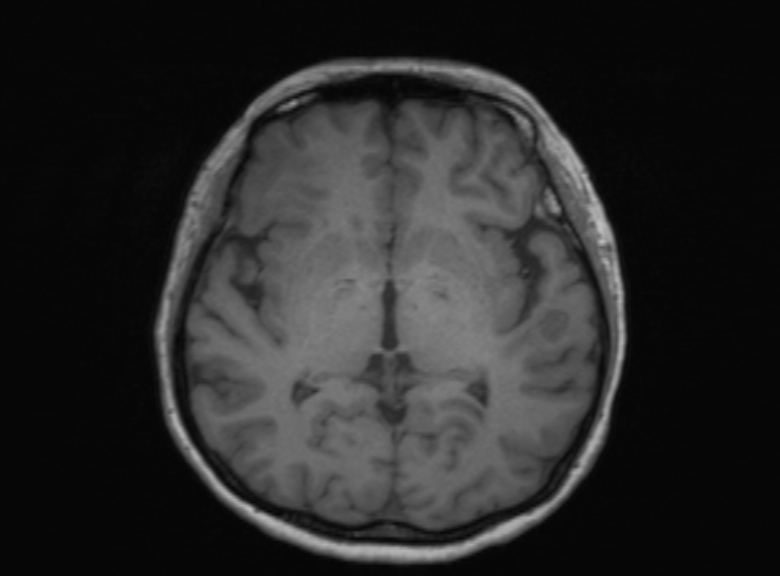 Cerebral ring enhancing lesions - cerebral metastases (Radiopaedia 44922-48817 Axial T1 232).jpg