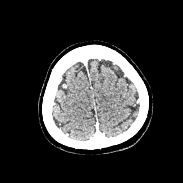 Cerebral ring enhancing lesions - cerebral metastases (Radiopaedia 44922-48818 B 247).jpg