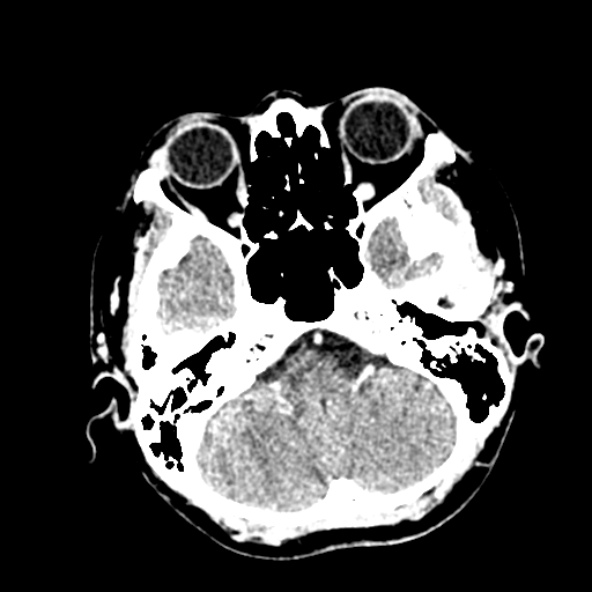 File:Cerebral ring enhancing lesions - cerebral metastases (Radiopaedia 44922-48818 B 63).jpg