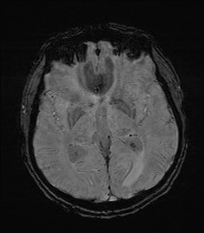 File:Cerebral toxoplasmosis (Radiopaedia 43956-47461 Axial SWI 19).jpg