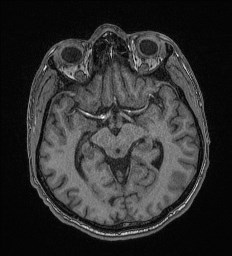 Cerebral toxoplasmosis (Radiopaedia 43956-47461 Axial T1 32).jpg
