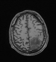 Cerebral toxoplasmosis (Radiopaedia 43956-47461 Axial T1 63).jpg
