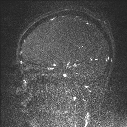 Cerebral tuberculosis with dural sinus invasion (Radiopaedia 60353-68090 Sagittal MRV 55).jpg