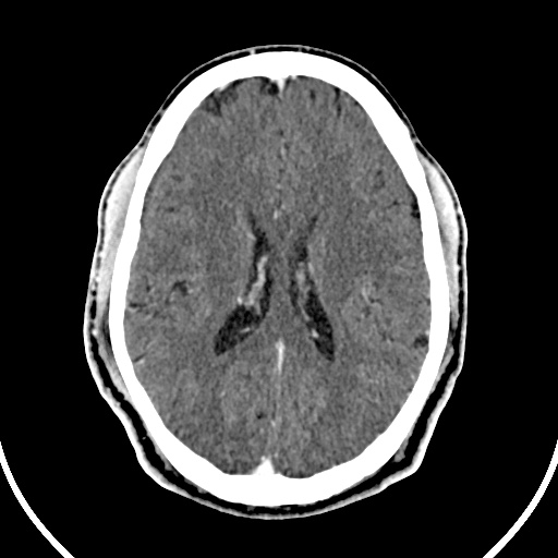 Cerebral venous angioma (Radiopaedia 69959-79977 B 59).jpg