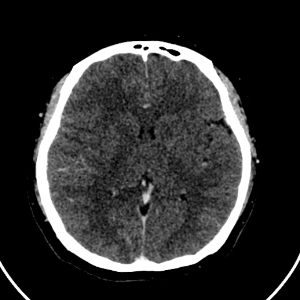 File:Cerebral venous hemorrhagic infarct from venous sinus thrombosis (Radiopaedia 55433-61883 Axial C+ delayed 74).jpg