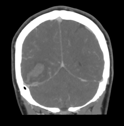 Cerebral venous hemorrhagic infarction (Radiopaedia 38461-40550 Coronal MIP VENOGRAM 45).png