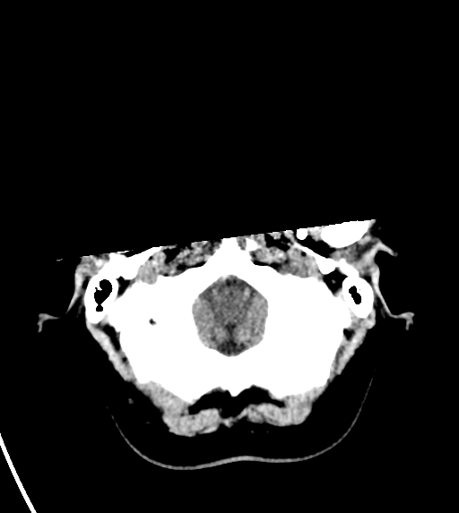 File:Cerebral venous infarct related to dural venous sinus thromboses (Radiopaedia 35292-36804 Axial non-contrast 4).png