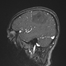 Cerebral venous infarction - hemorrhagic (Radiopaedia 81625-95505 Sagittal MRV 20).jpg