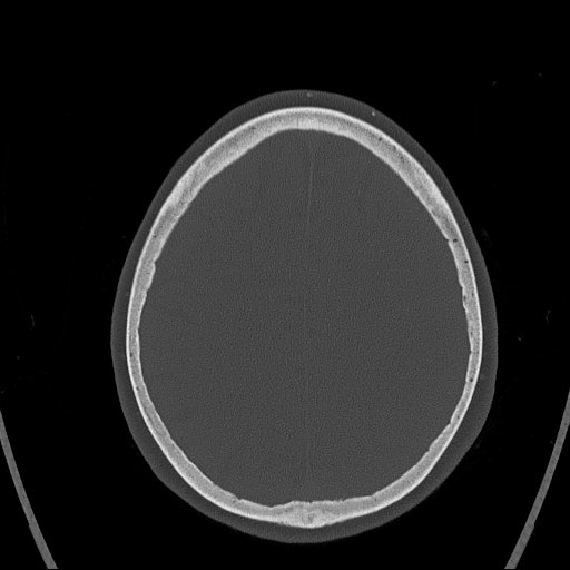 Cerebral venous infarction with hemorrhage (Radiopaedia 65343-74381 Axial bone window 142).jpg