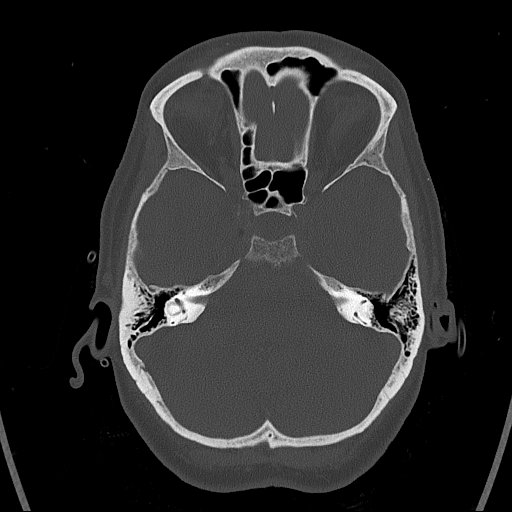 Cerebral venous infarction with hemorrhage (Radiopaedia 65343-74381 Axial bone window 33).jpg