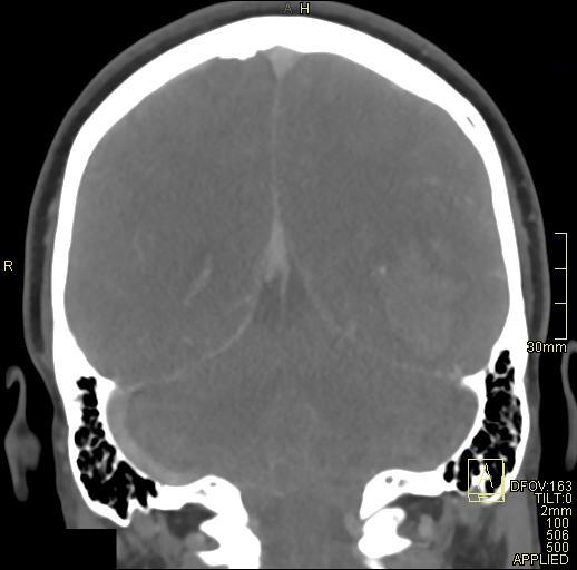 File:Cerebral venous sinus thrombosis (Radiopaedia 91329-108965 Coronal venogram 61).jpg