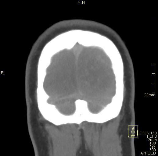 File:Cerebral venous sinus thrombosis (Radiopaedia 91329-108965 Coronal venogram 81).jpg