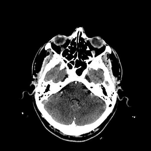 File:Cerebral venous thrombosis (CVT) (Radiopaedia 77524-89685 Axial with contrast 10).jpg