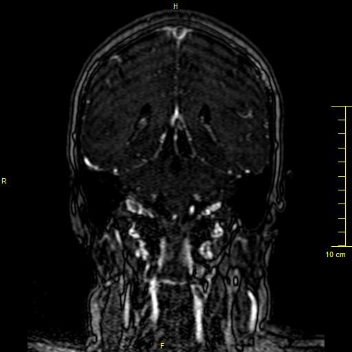 File:Cerebral venous thrombosis (Radiopaedia 23288-23351 MRV 104).JPG